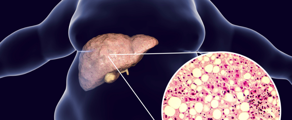 Non Alcoholic Fatty Liver Disease